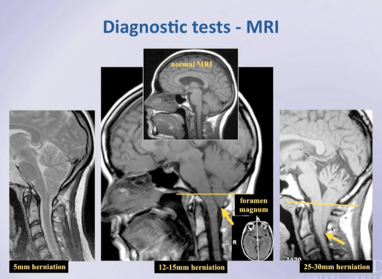 Chiari Malformation MRI